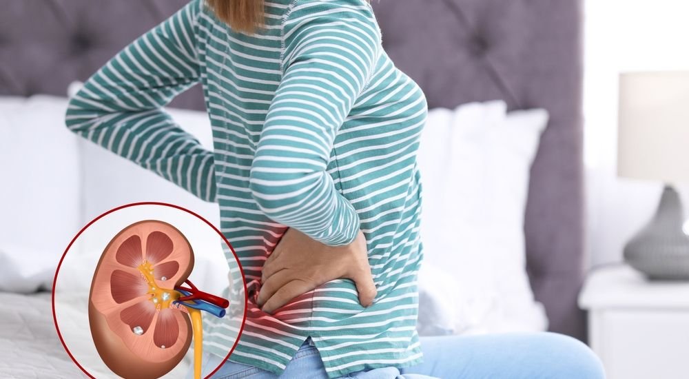 Common Symptoms of Kidney Stones in Women