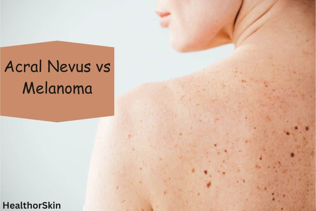 Acral Nevus vs Melanoma: What's the Difference