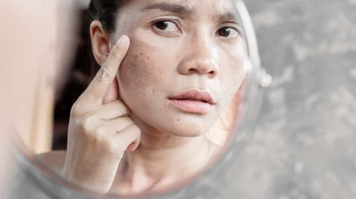 Erase Dark Spots Your Complete Guide To Triamcinolone - bl6lrx0