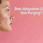 Does Adapalene Cause Skin Purging