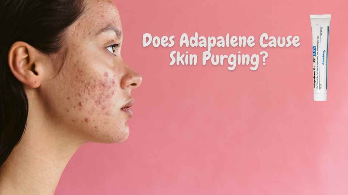 Does Adapalene Cause Skin Purging