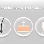 Does Hyaluronic Acid Cause Breakouts